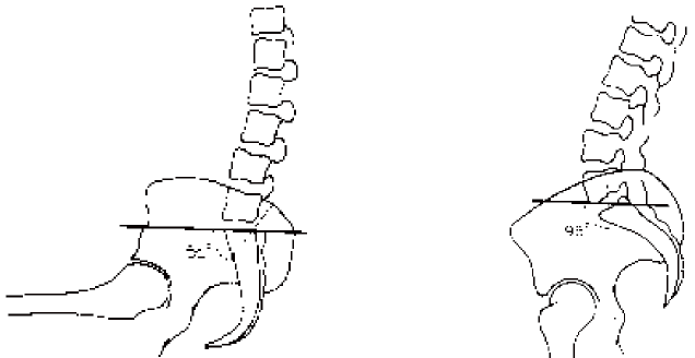 図1骨盤の傾斜の変化