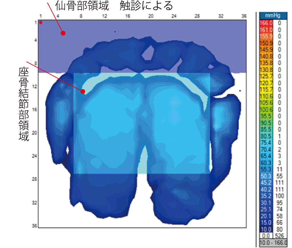 図2仙骨あり